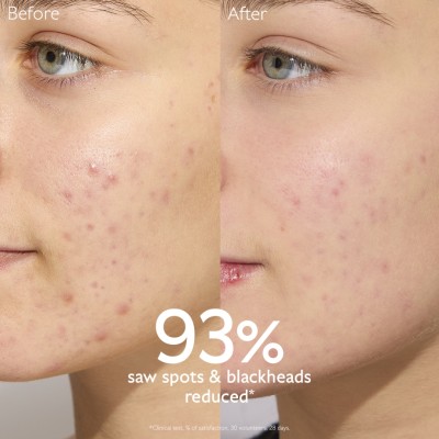 Caudalie Vinopure Salicylic Spot Solution Κρέμα Τοπικής Εφαρμογής Για Σπυράκια & Ερυθρότητα 15ml